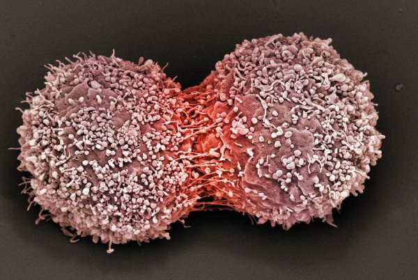 Иммунотерапия победила самый агрессивный тип рака груди | 42.TUT.BY - «Интернет и связь»